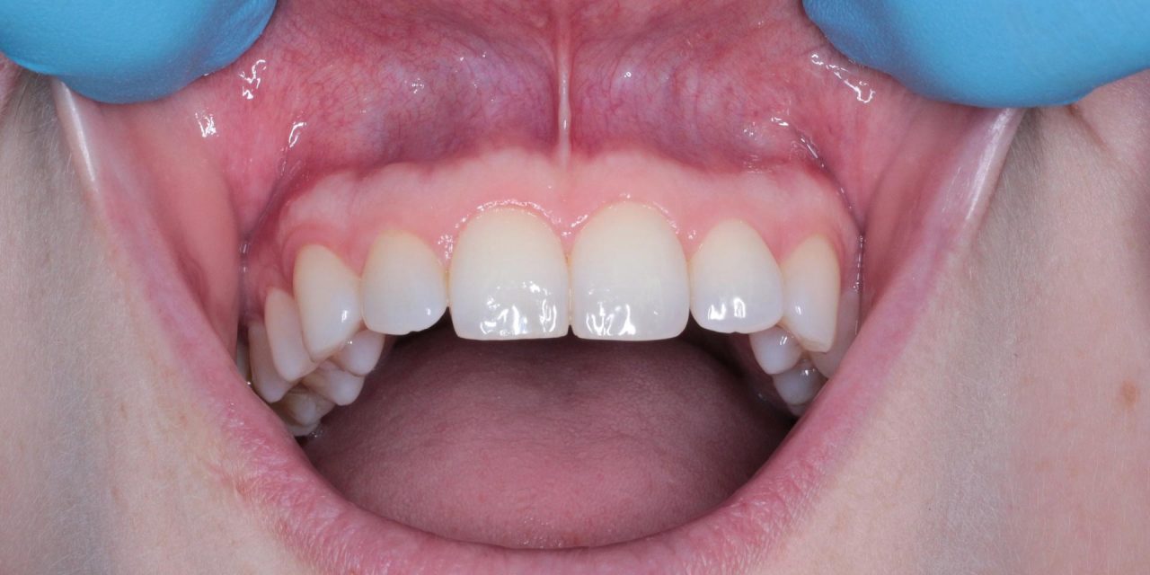 Pit and Fissure Sealants: Safeguarding Smiles